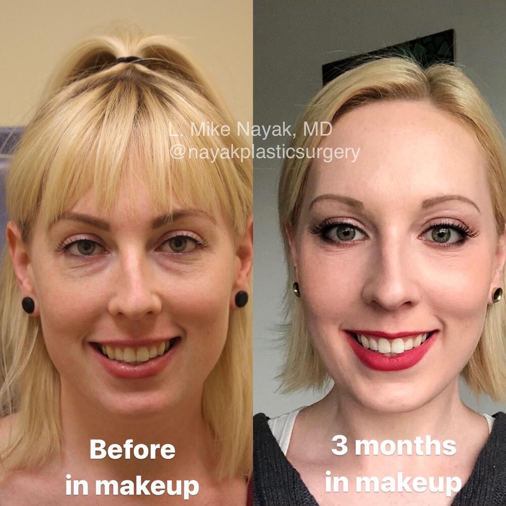 Blepharoplasty Before & After Image