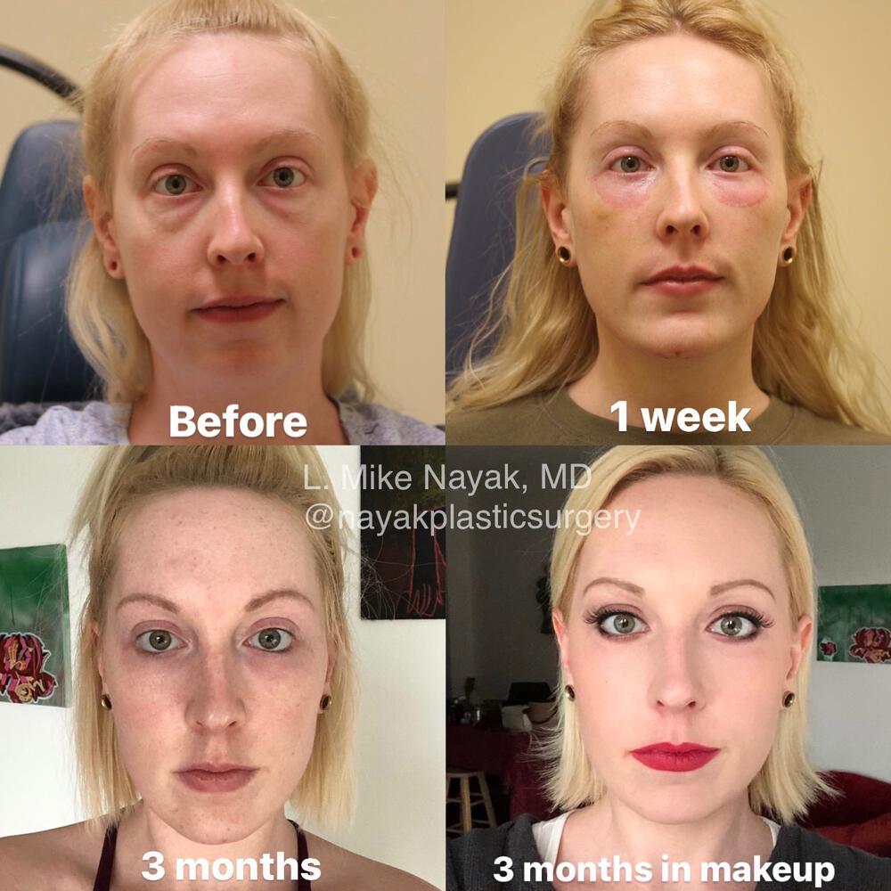 Blepharoplasty Before & After Image