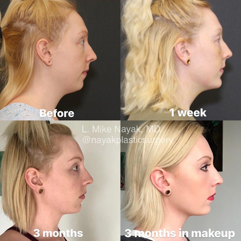 Blepharoplasty Before & After Image