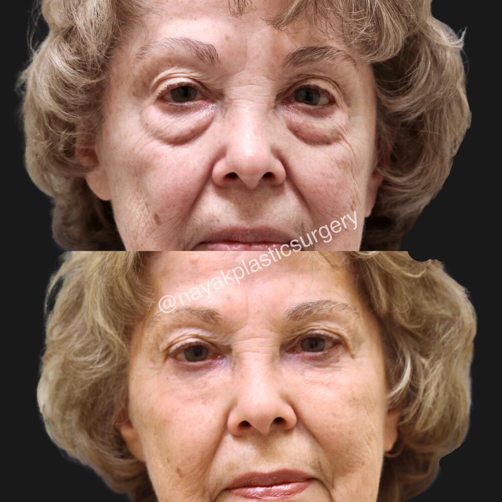 Blepharoplasty Before & After Image