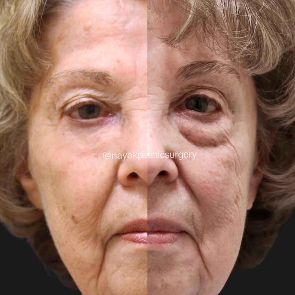 Blepharoplasty Before & After Image