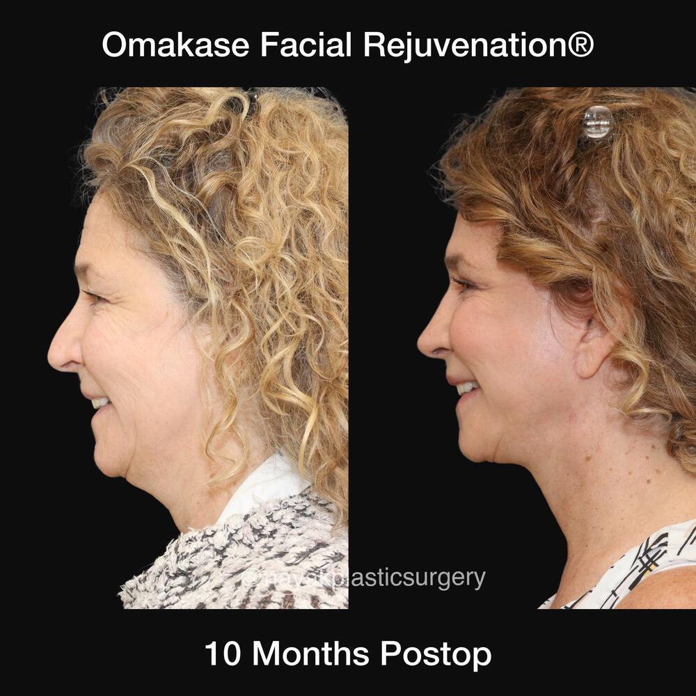 Blepharoplasty Before & After Image