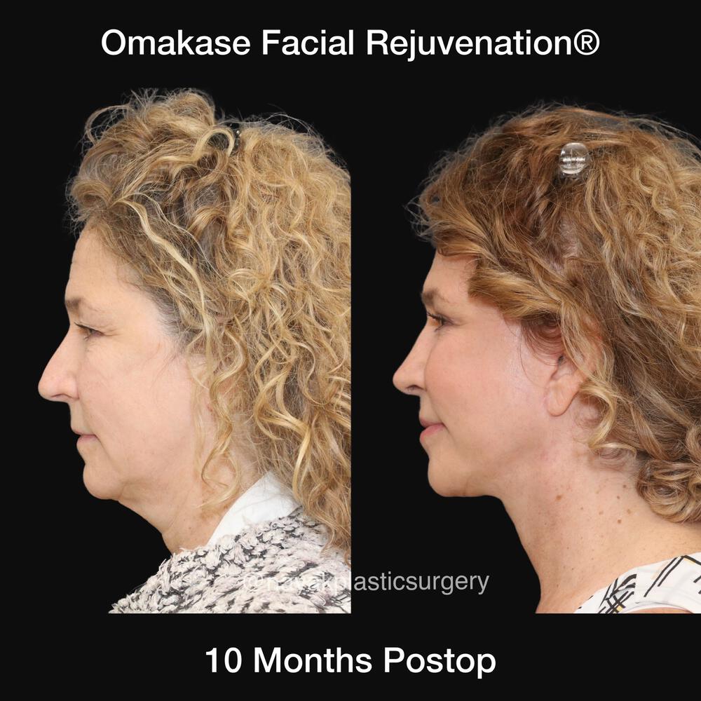 Blepharoplasty Before & After Image