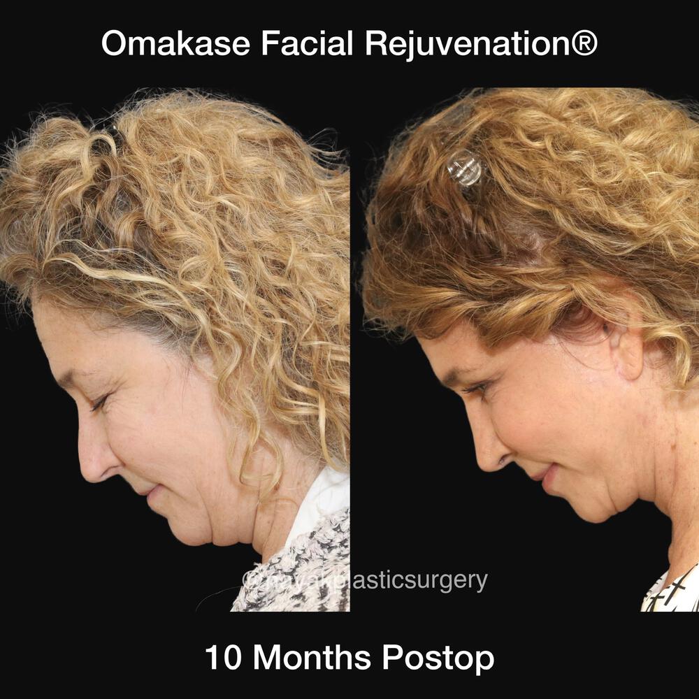 Blepharoplasty Before & After Image