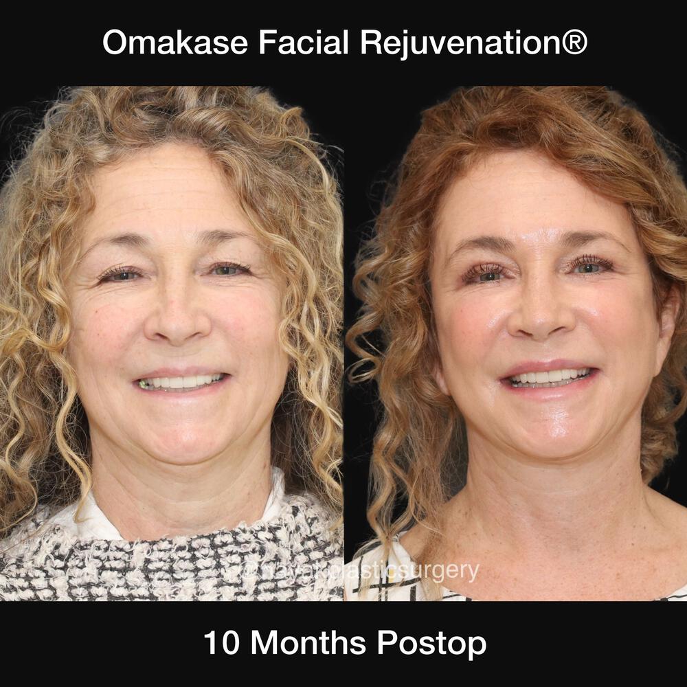 Blepharoplasty Before & After Image