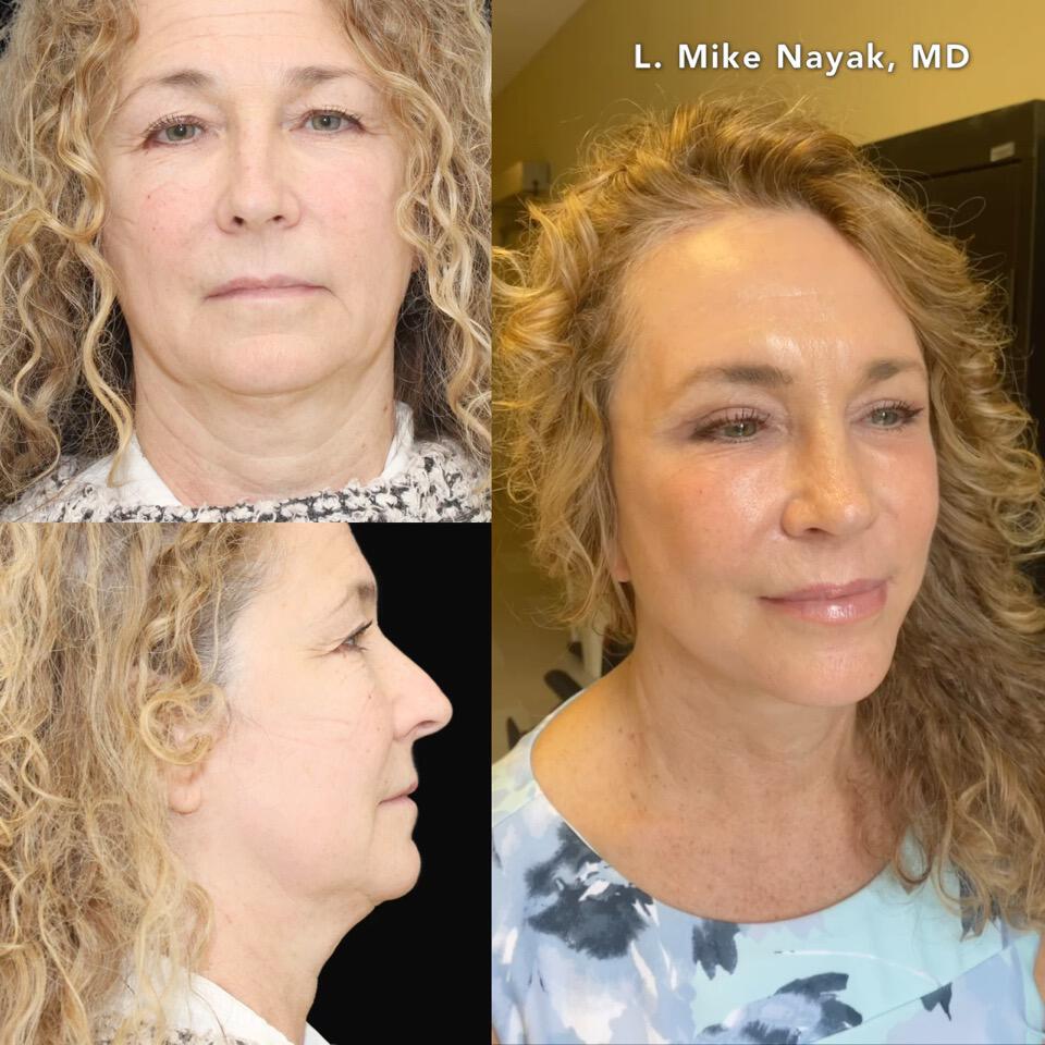 Blepharoplasty Before & After Image