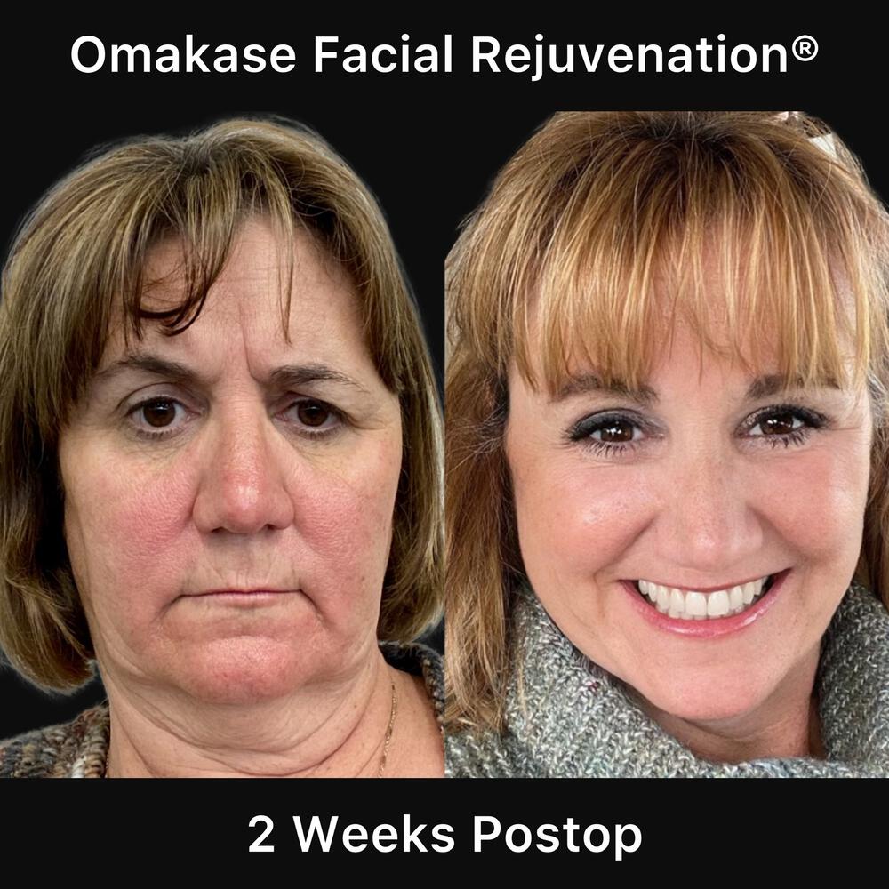 Blepharoplasty Before & After Image