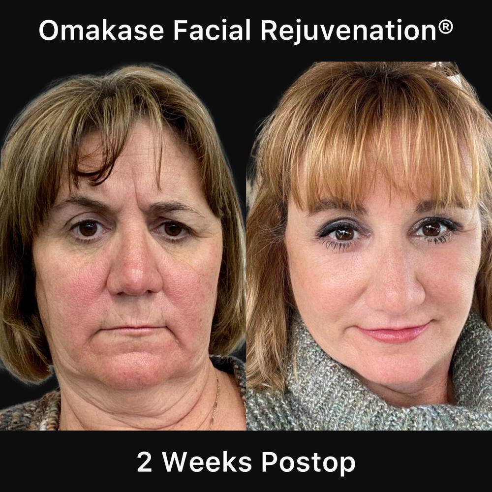 Blepharoplasty Before & After Image