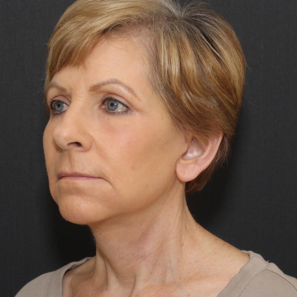 Blepharoplasty Before & After Image