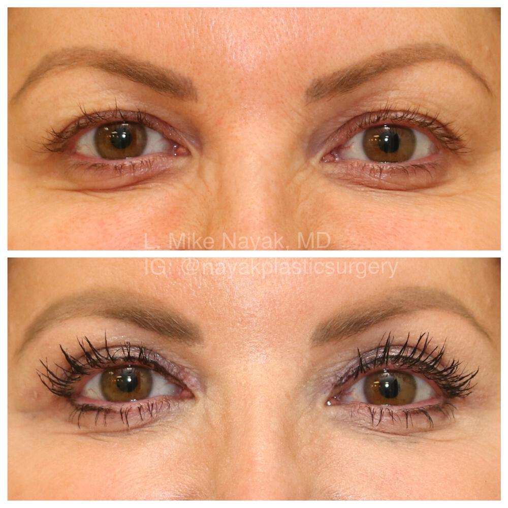 Blepharoplasty Before & After Image