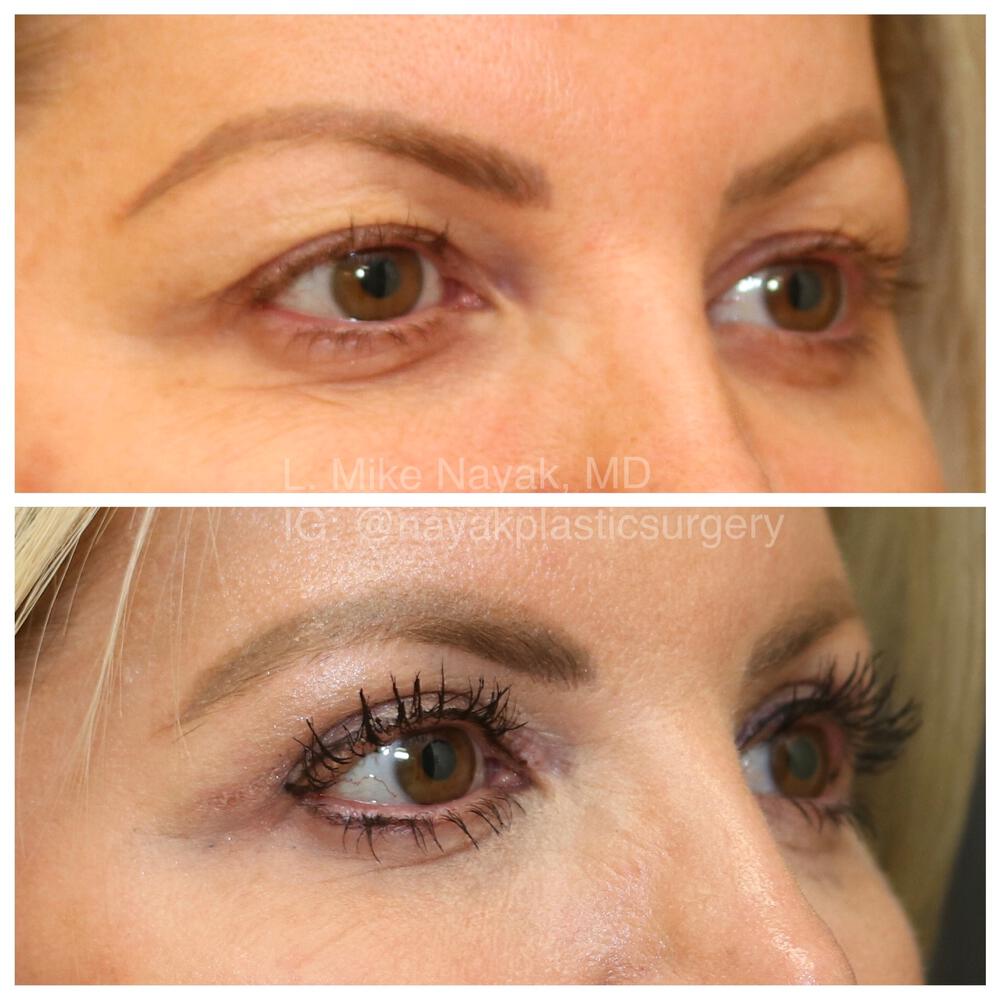 Blepharoplasty Before & After Image