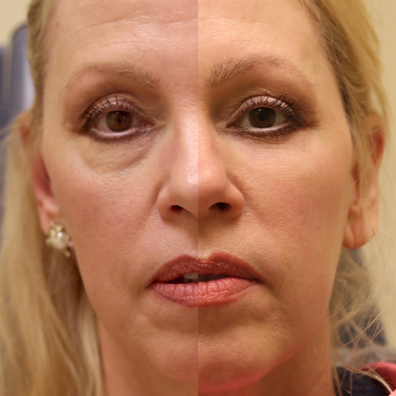 Blepharoplasty Before & After Image