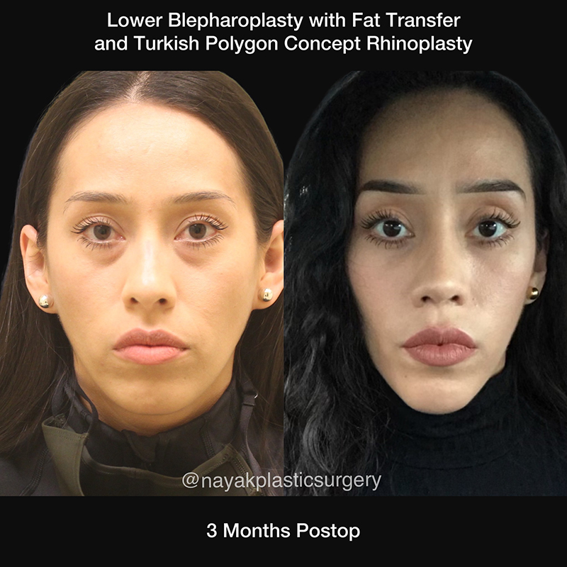 Blepharoplasty Before & After Image