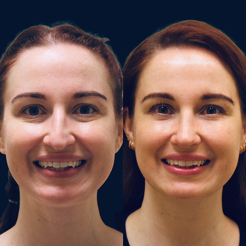 Blepharoplasty Before & After Image