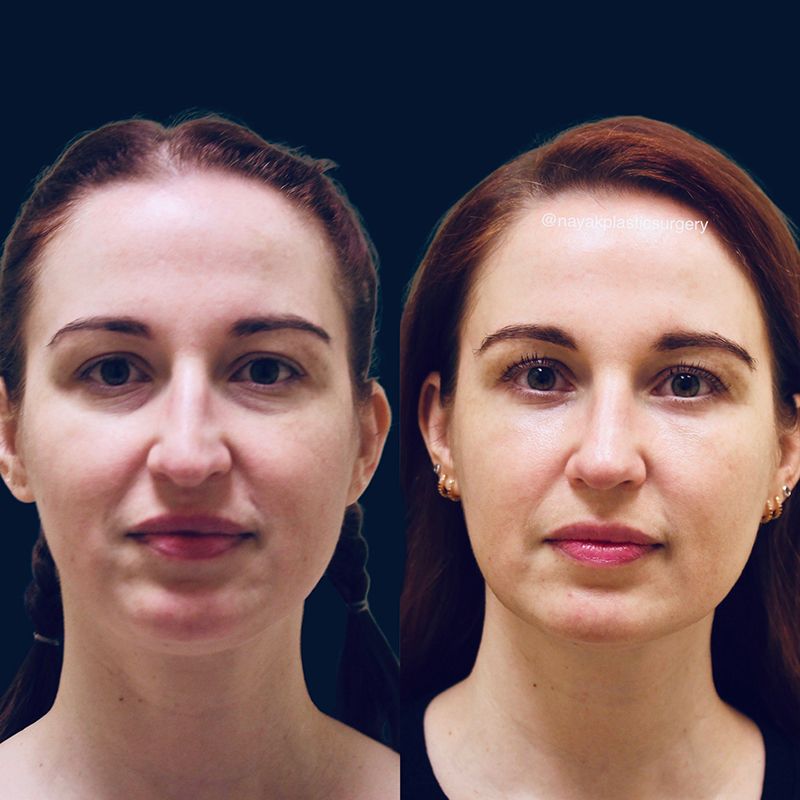 Blepharoplasty Before & After Image