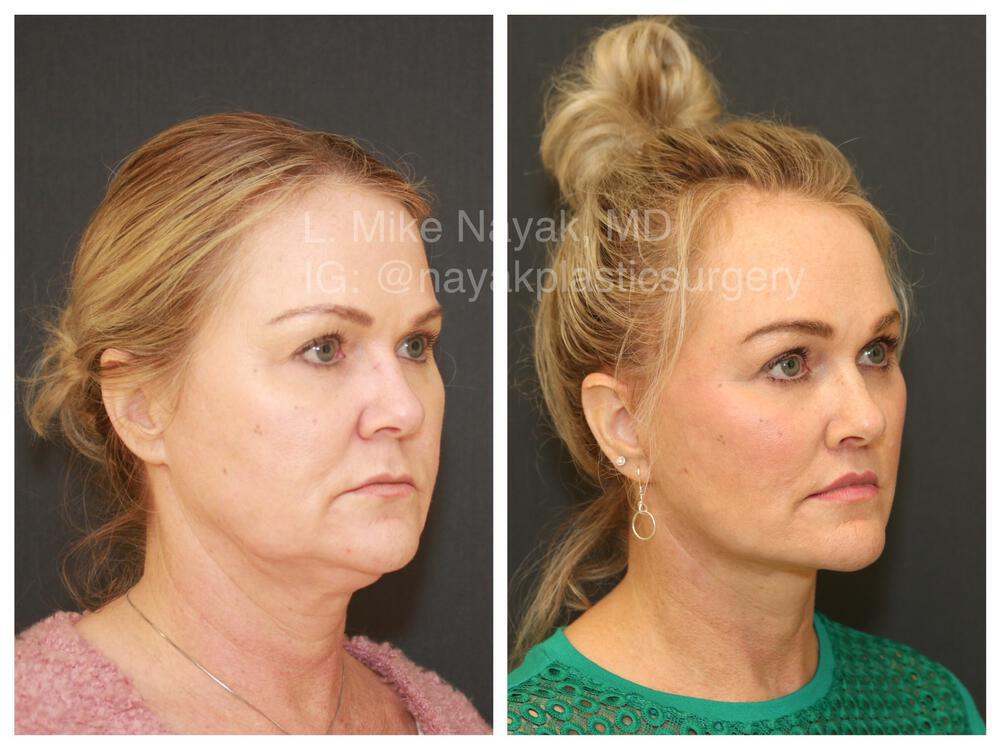 Brow Lift Before & After Image