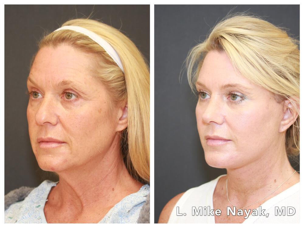 Brow Lift Before & After Image