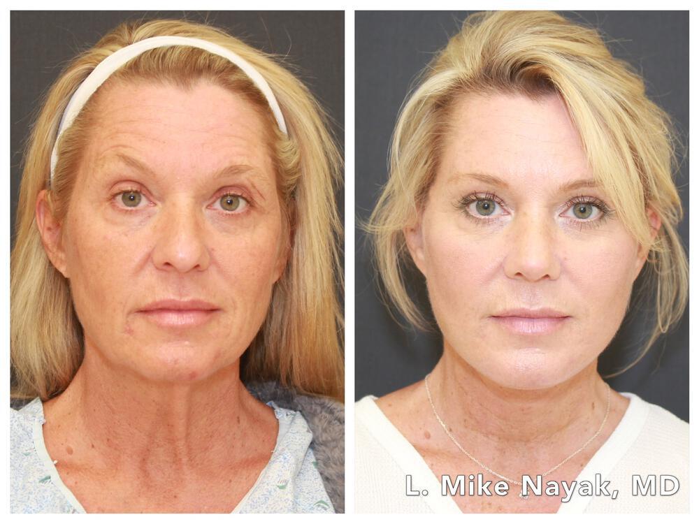 Brow Lift Before & After Image