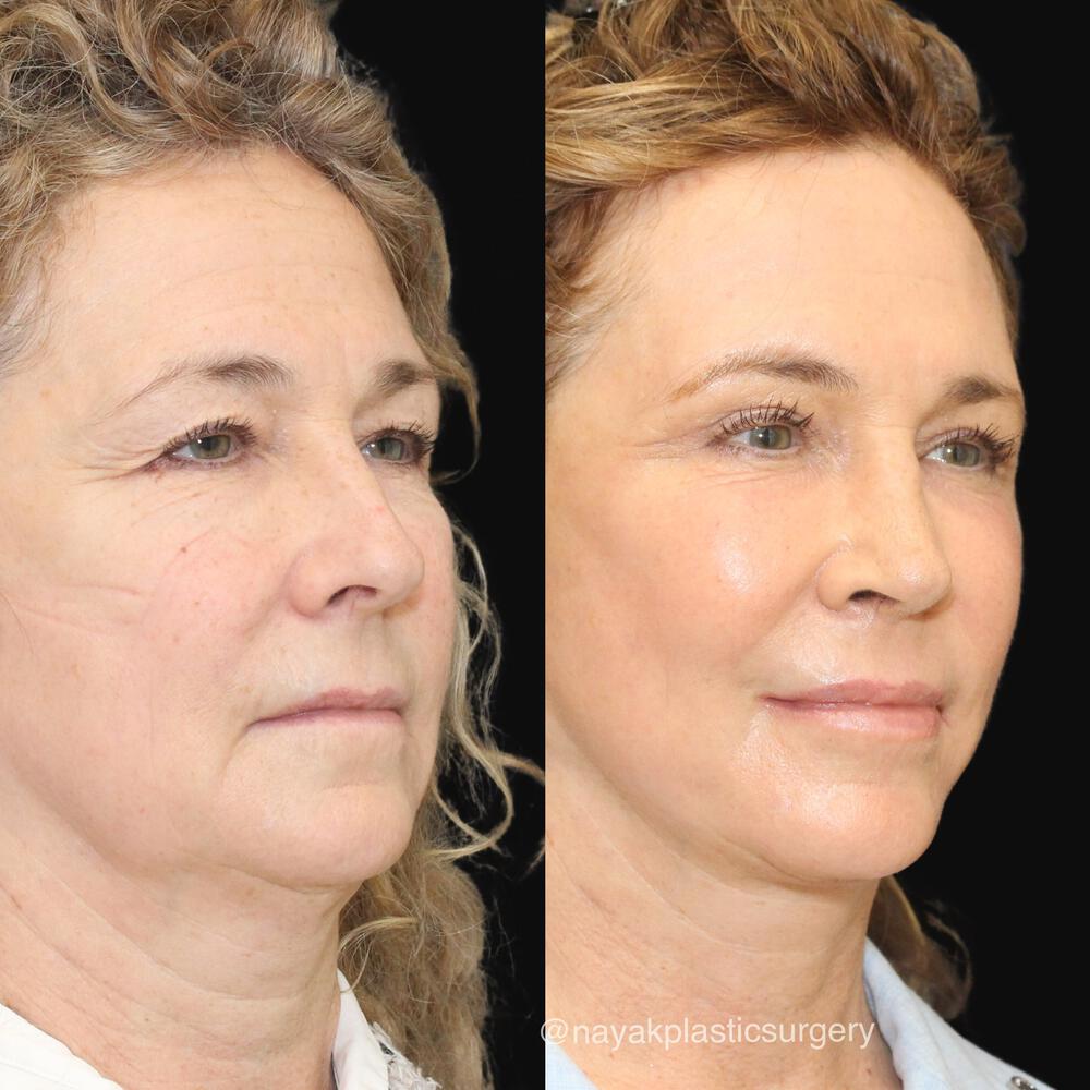 Brow Lift Before & After Image