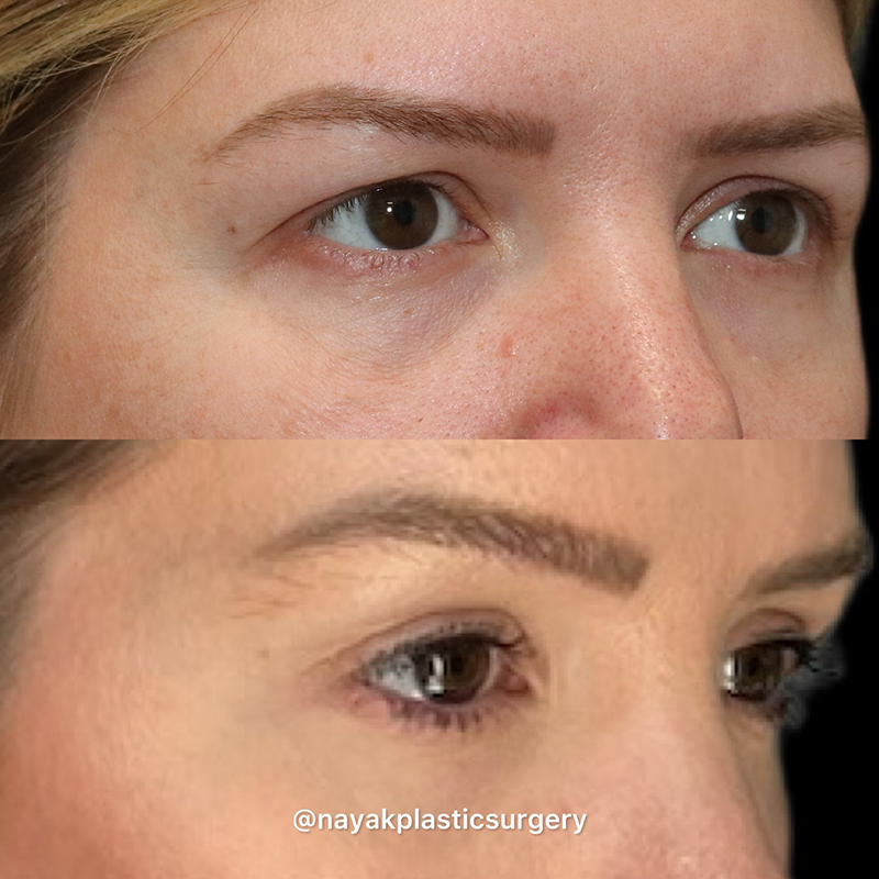 Brow Lift Before & After Image