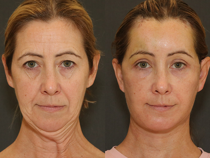 Brow Lift Before & After Image