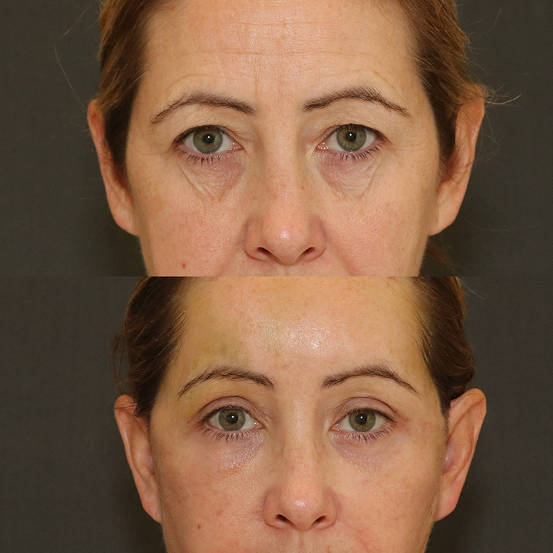 Brow Lift Before & After Image