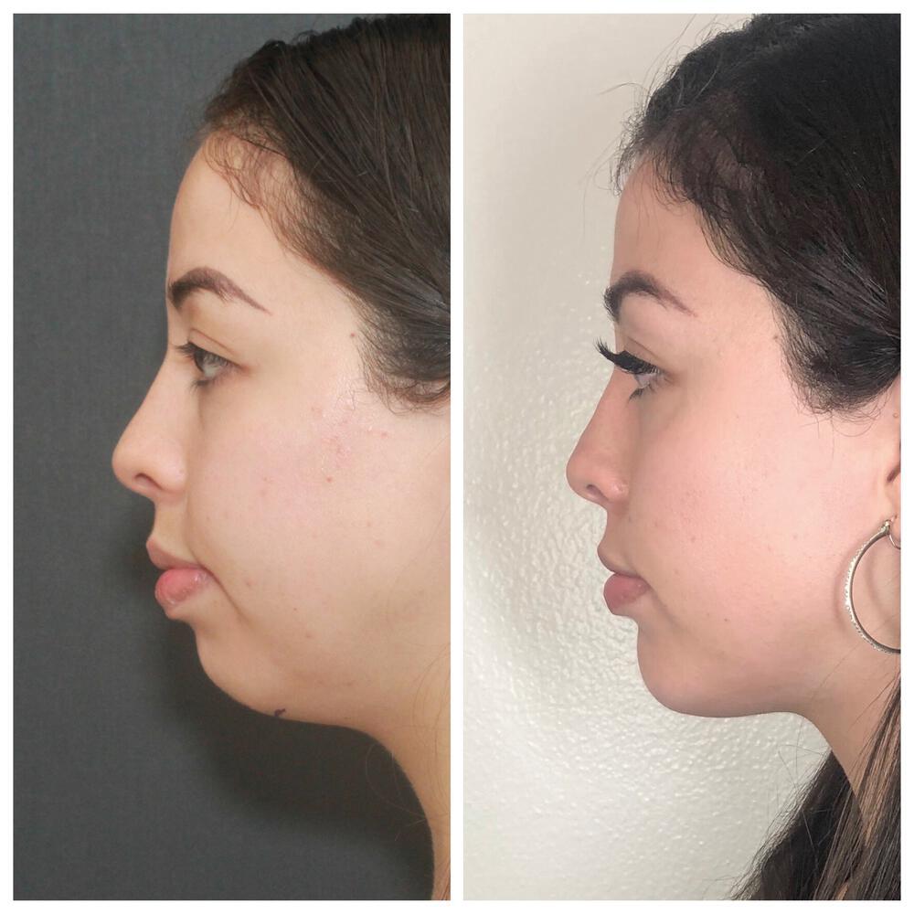 Buccal Fat Removal Before & After Image