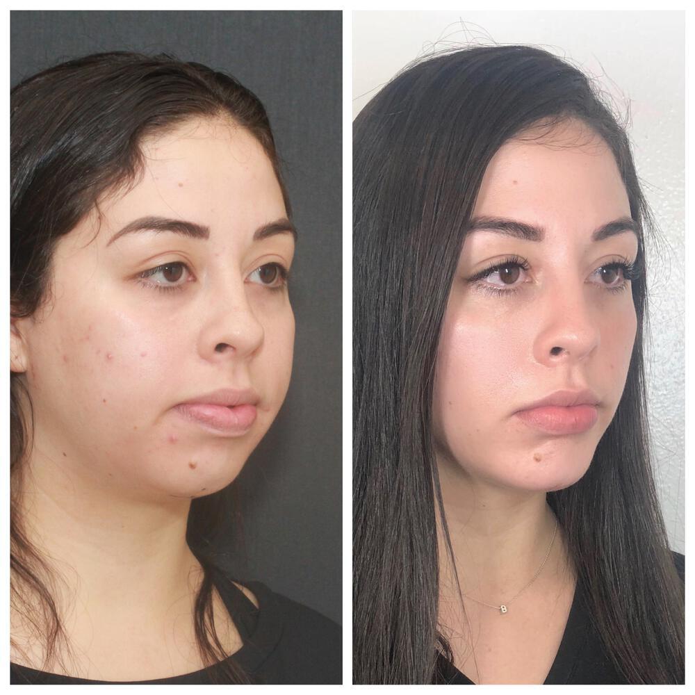 Buccal Fat Removal Before & After Image