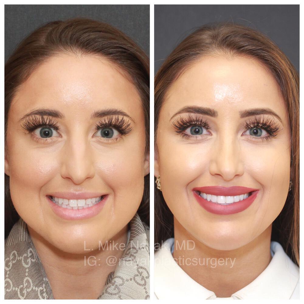 Buccal Fat Removal Before & After Image