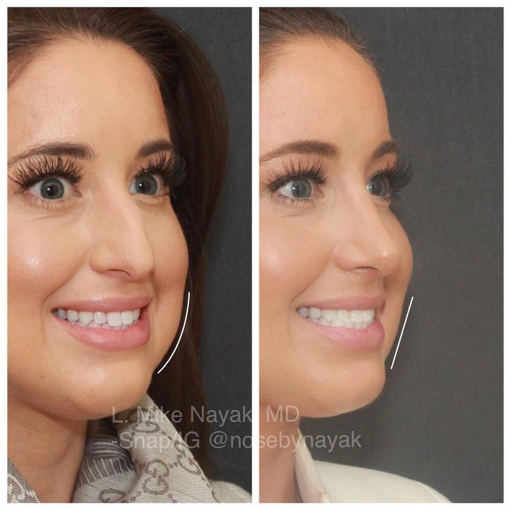 Buccal Fat Removal Before & After Image