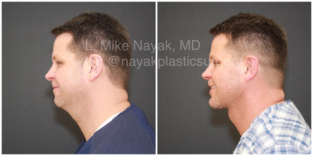 Buccal Fat Removal Before & After Image