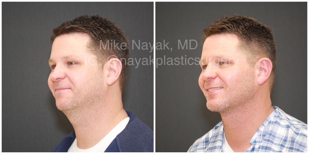 Buccal Fat Removal Before & After Image