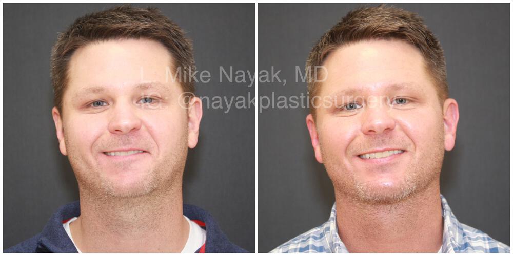 Buccal Fat Removal Before & After Image