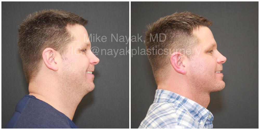 Buccal Fat Removal Before & After Image