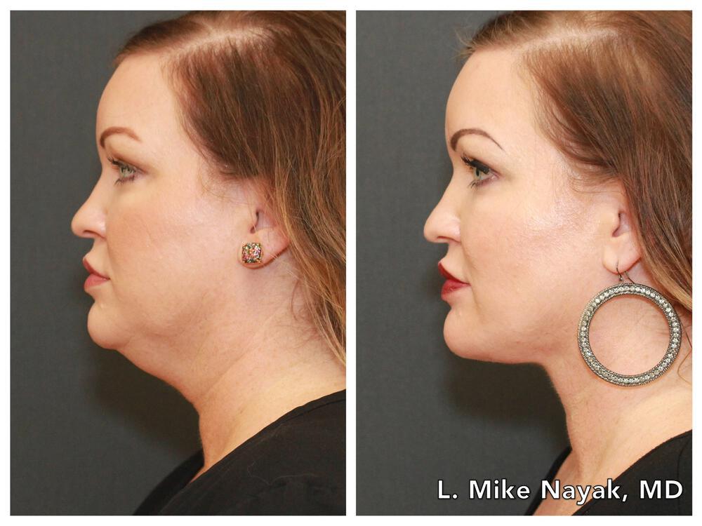 Buccal Fat Removal Before & After Image