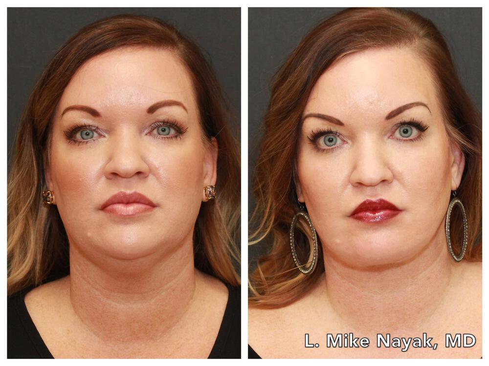 Buccal Fat Removal Before & After Image