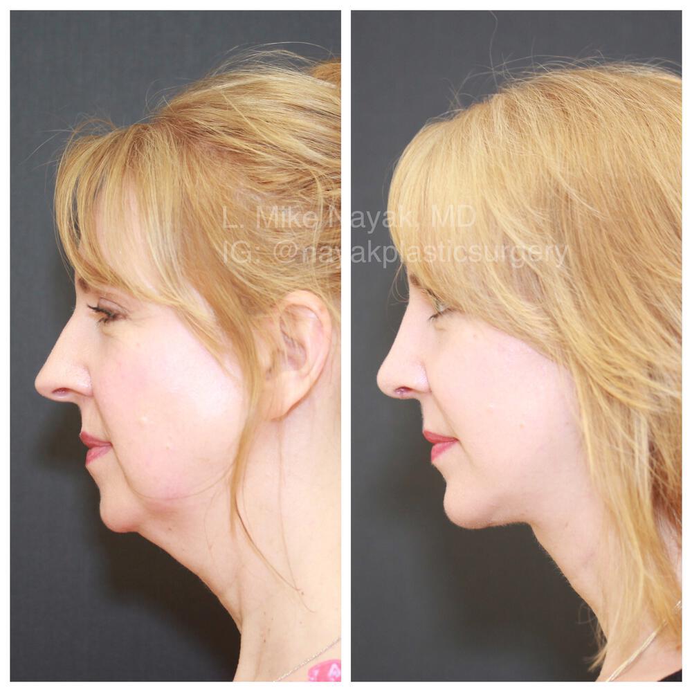 Buccal Fat Removal Before & After Image