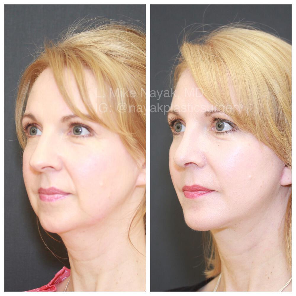 Buccal Fat Removal Before & After Image