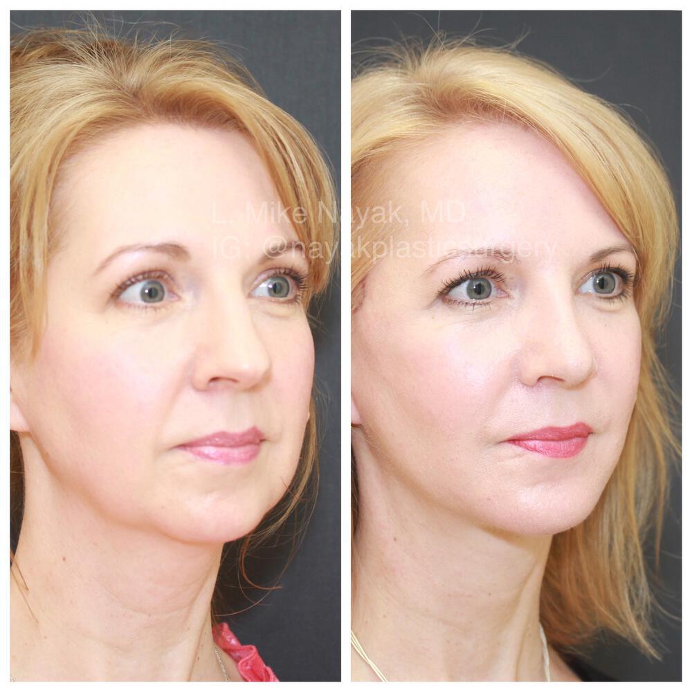 Buccal Fat Removal Before & After Image