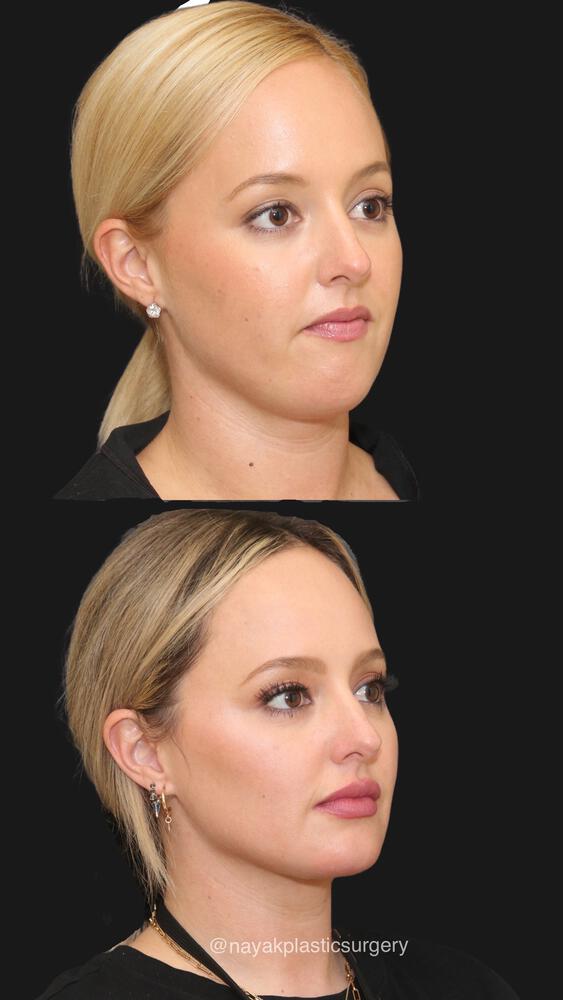 Buccal Fat Removal Before & After Image