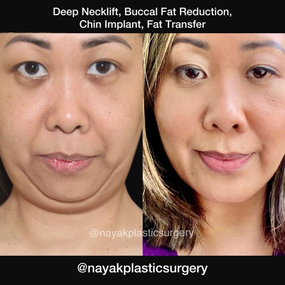 Buccal Fat Removal Before & After Image