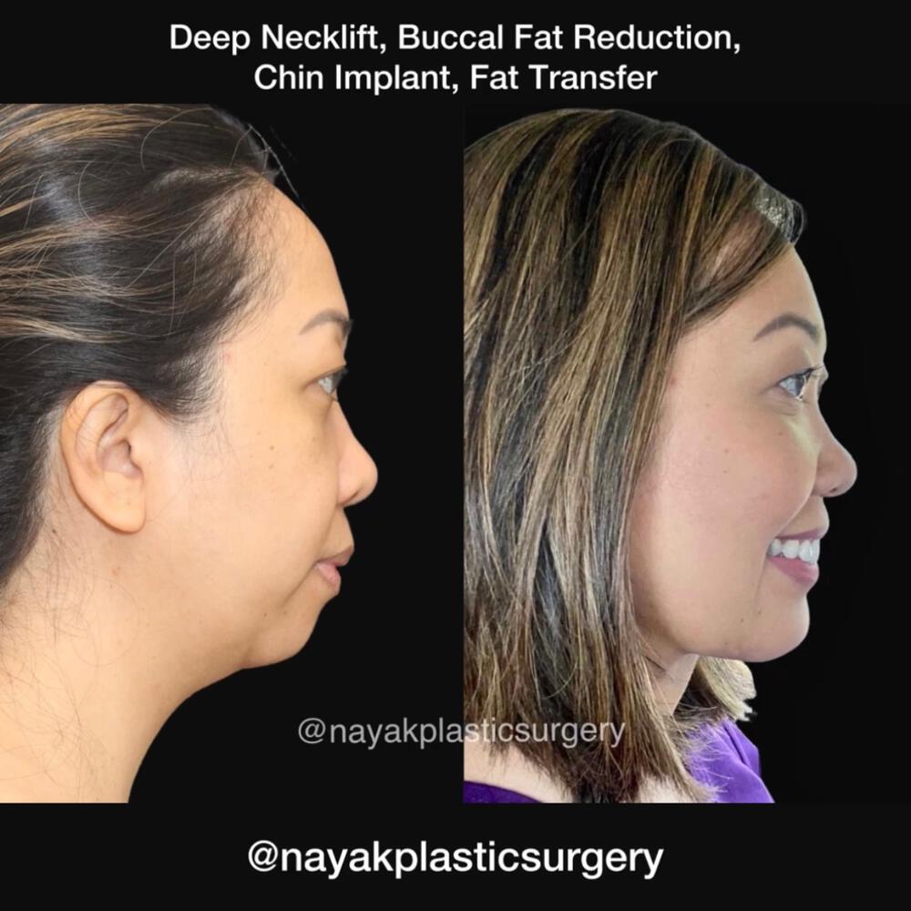 Buccal Fat Removal Before & After Image