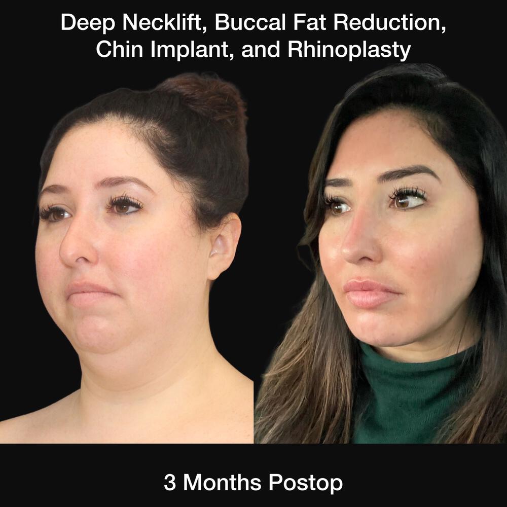 Buccal Fat Removal Before & After Image