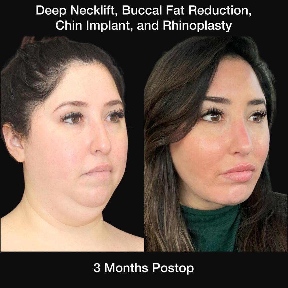 Buccal Fat Removal Before & After Image