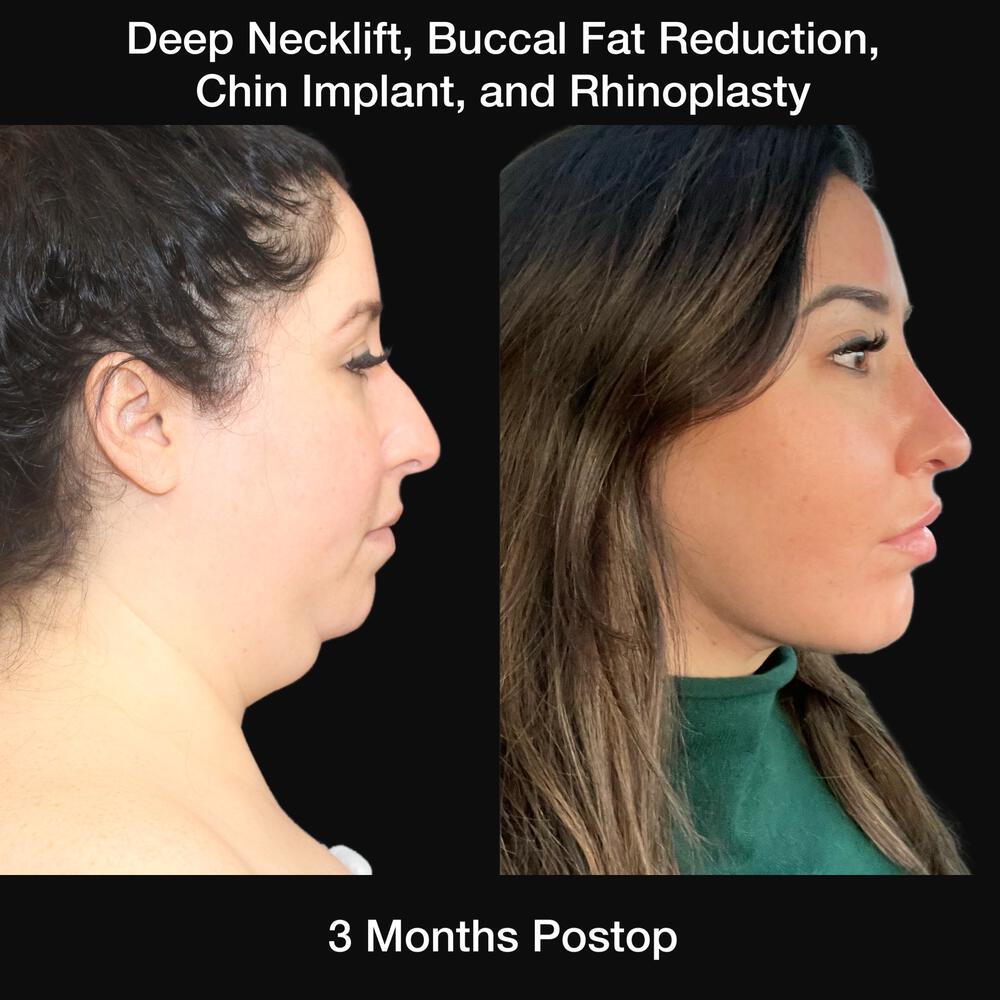 Buccal Fat Removal Before & After Image