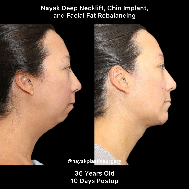 Buccal Fat Removal Before & After Image