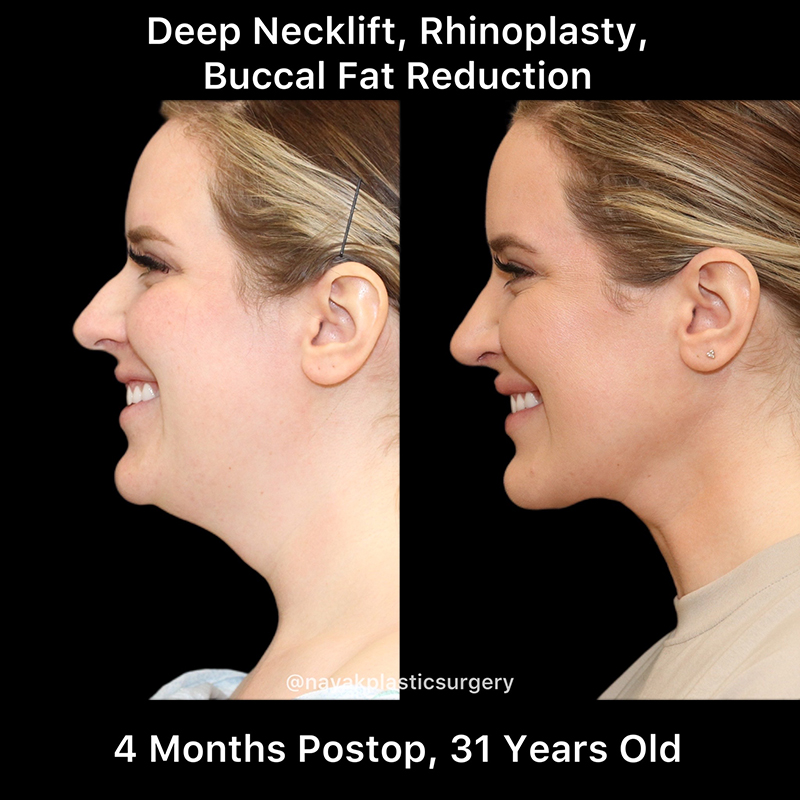 Buccal Fat Removal Before & After Image