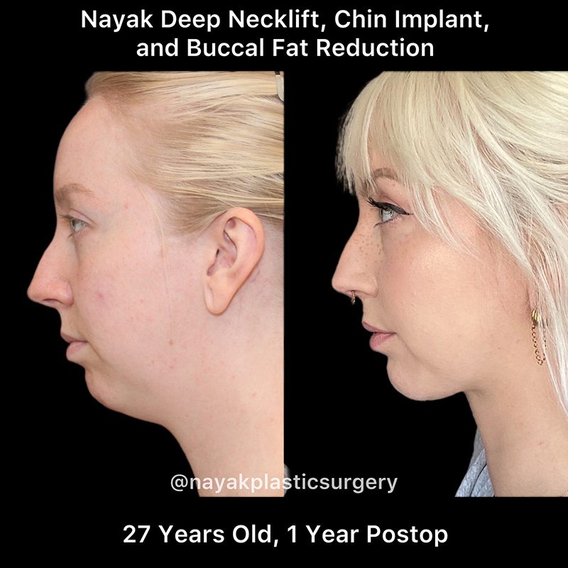 Buccal Fat Removal Before & After Image