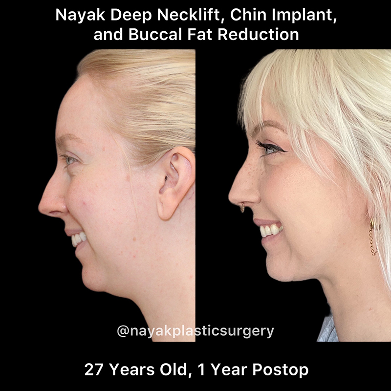 Buccal Fat Removal Before & After Image