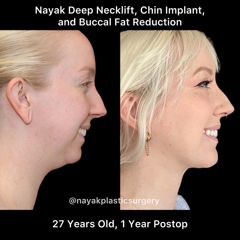 Buccal Fat Removal Before & After Image